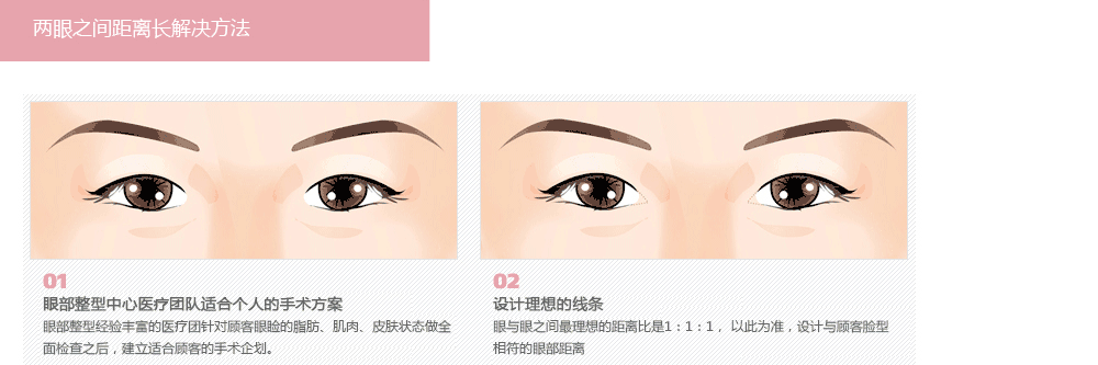 韩式双眼皮手术
