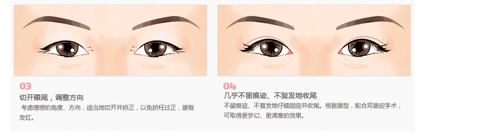 韩国做双眼皮手术哪里好