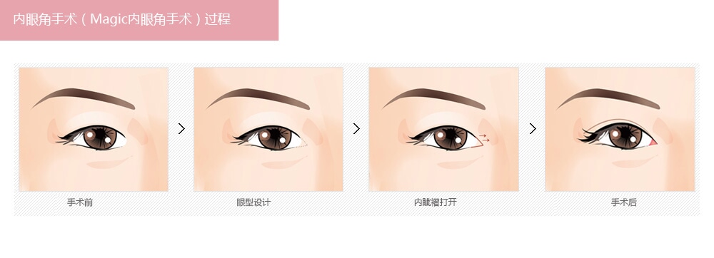 开内眼角手术有几种