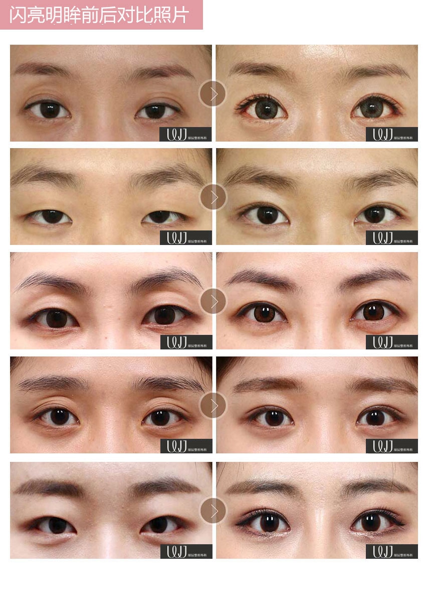 闪亮明眸（非切开提肌矫正术）