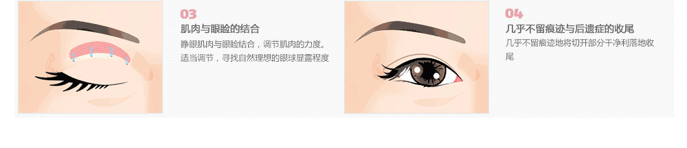 眼部整形需要多少钱