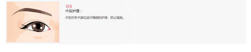 双眼皮线不对称