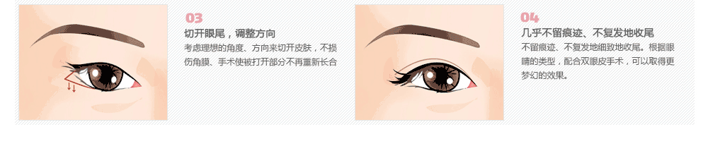 韩式眼部整形术