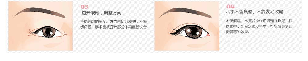 韩式割双眼皮手术多少钱