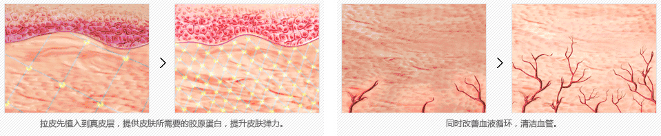 超级v拉皮的原理