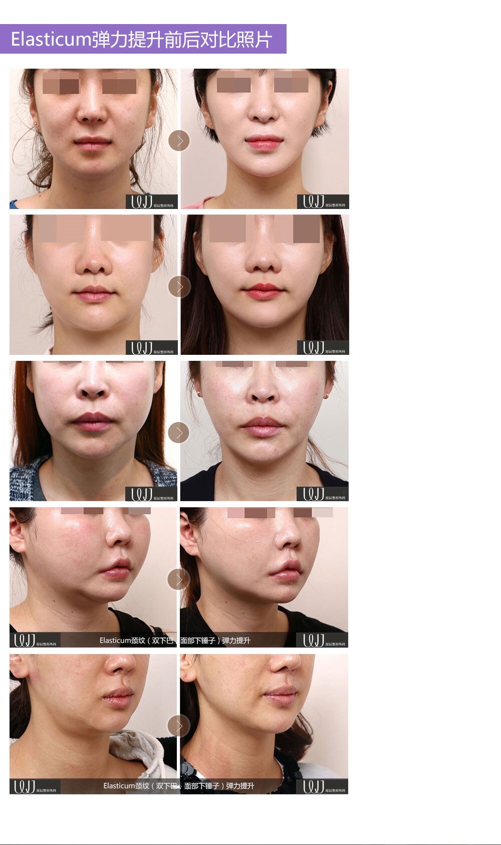 Elasticum弹力提升技术