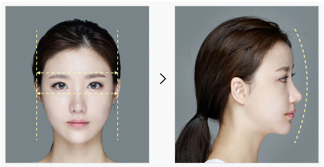 韩国颧骨整形术后护理