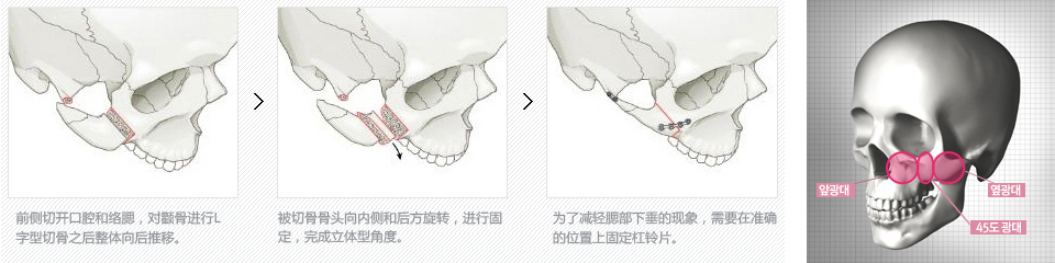 韩国颧骨整形术后护理