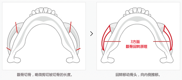 韩国颧骨整形术后护理