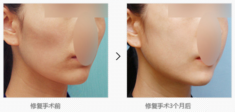 韩国下巴整形哪里效果好
