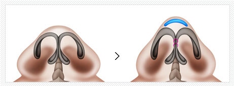 韩国鼻头整形哪家效果