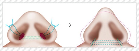 鼻翼缩小术价格