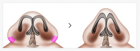 鼻翼缩小术价格