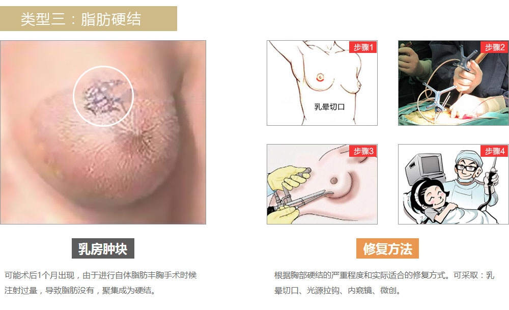 韩国隆胸失败修5