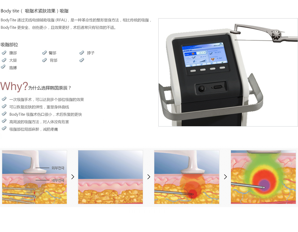 韩式吸脂减肥需要多少钱