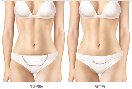 整形腹部整形