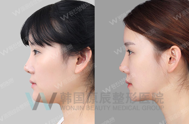 线提升案例-韩国原辰整形外科医院