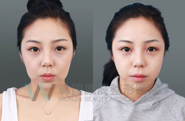 线提升案例-韩国原辰整形外科医院