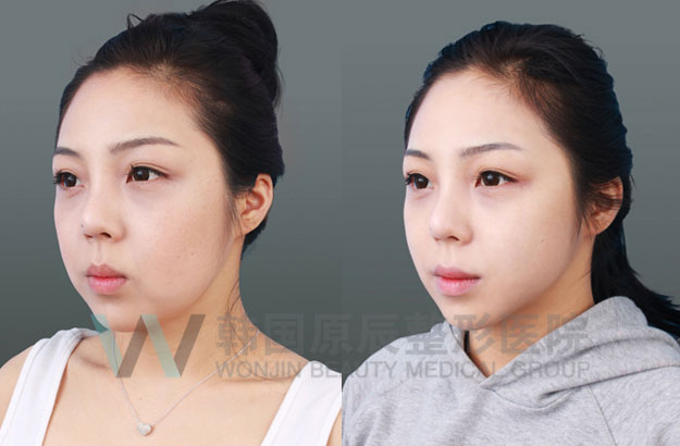 线提升案例-韩国原辰整形外科医院